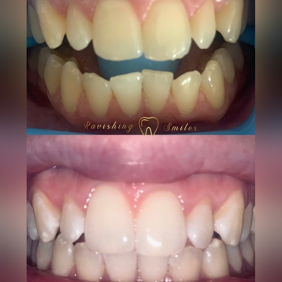 Teeth Whitening Pen. 16% Hydrogen Peroxide. No LED Accelerator Light needed. - Picture 4 of 7